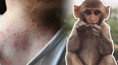 Cuáles son los síntomas de la viruela del mono y cómo se propaga