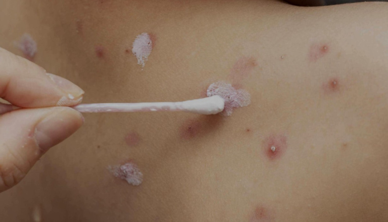 Alerta provincial por el incremento de cuadros de varicela en Tolhuin