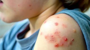 Sarampión: más de 250 personas en cuarentena y preocupación en Estados Unidos