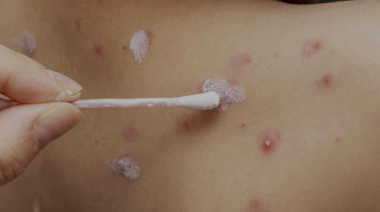 Alerta provincial por el incremento de cuadros de varicela en Tolhuin