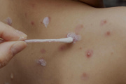 Alerta provincial por el incremento de cuadros de varicela en Tolhuin
